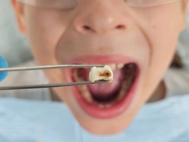 Best Emergency Treatment for Dental Infections or Abscesses in Pembroke, NC